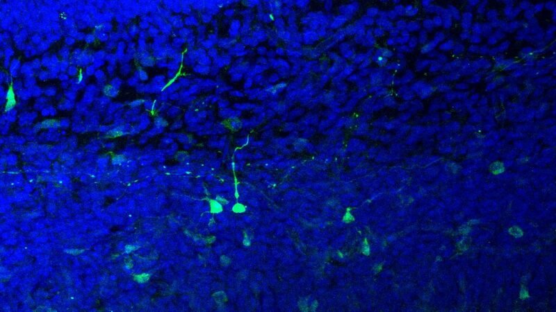 La biologia femminile e il Parkinson: come i geni proteggono il cervello delle donne