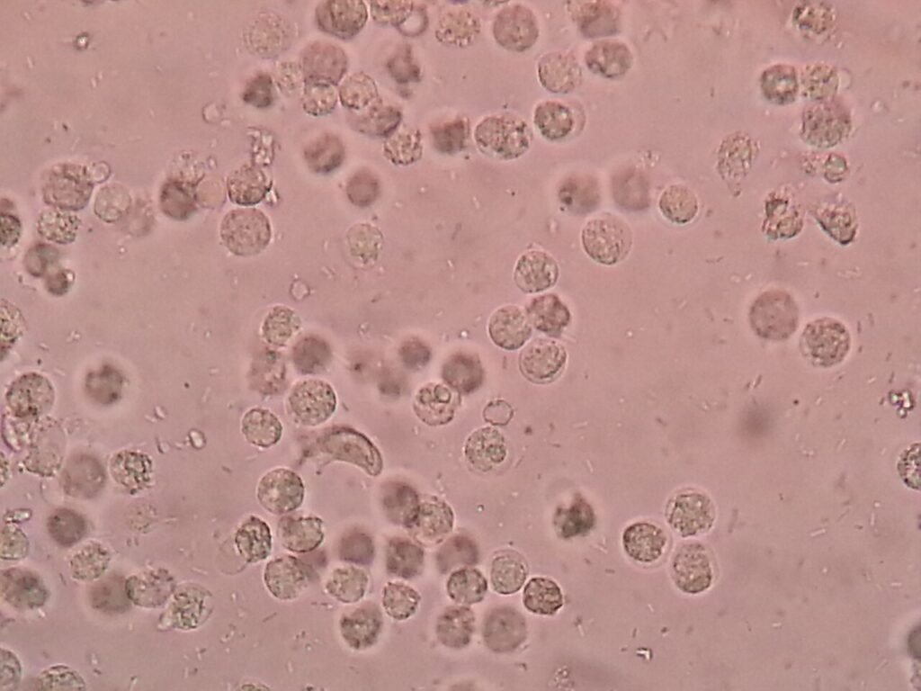 Cellule immunitarie riprogrammate: una strategia nuova per l'artrite reumatoide grave