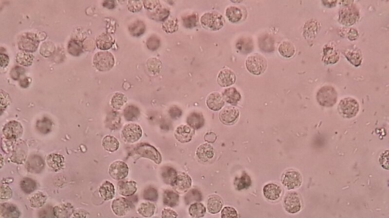 Cellule immunitarie riprogrammate: una strategia nuova per l'artrite reumatoide grave